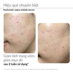 Serum Ekseption Kẽm ZNPCA Hyaluronic Mixlab 75ml hỗ trợ kiểm soát dầu nhờn, dưỡng ẩm cho da mịn màng Serum Ekseption Kẽm ZNPCA Hyaluronic Mixlab 75ml hỗ trợ kiểm soát dầu nhờn, dưỡng ẩm cho da mịn màng